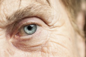 Eyelid Surgery